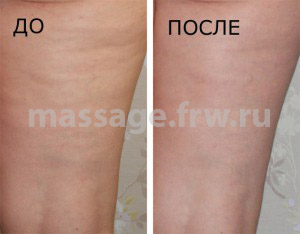 до и после антицеллюлитного массажа